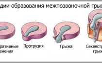 Упражнения для лечения грыж позвоночника