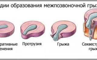 Упражнения для лечения грыж позвоночника