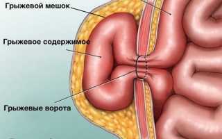 Что такое грыжа передней брюшной стенки
