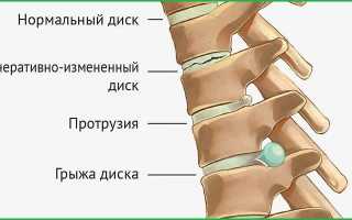 Что такое грыжа позвоночника и как ее лечить