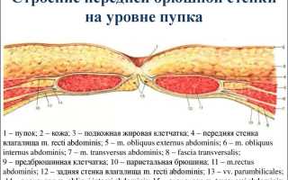 Что такое пупочная ущемленная грыжа