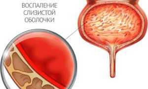 Цистит от переохлаждения