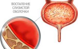 Цистит от переохлаждения