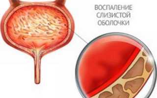 Моча с кровью при цистите