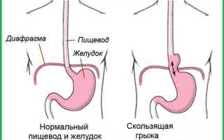 Скользящая грыжа пищевода (ГПОД), какие симптомы и лечение