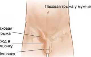 Что такое мошоночная грыжа