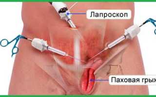 Как удаляют грыжу лапароскопией
