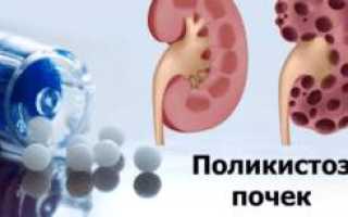 Поликистоз почек