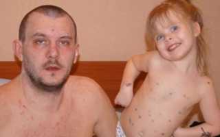 Вырабатывается ли иммунитет к ветрянке, если не заболел в детстве?