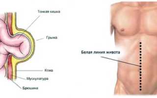Как лечить грыжу белой линии живота