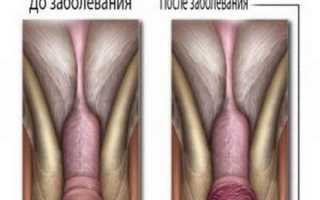 Воспаление головки и крайней плоти у мужчин