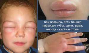Симптомы отека Квинке у детей, что предпринять в первую очередь