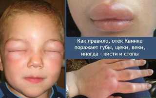 Симптомы отека Квинке у детей, что предпринять в первую очередь