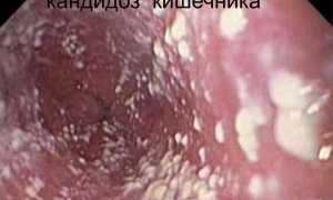 Лечение и профилактика анального кандидоза