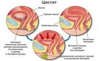 Цистит при климаксе