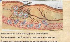 Виды экссудативного воспаления и терапия недуга