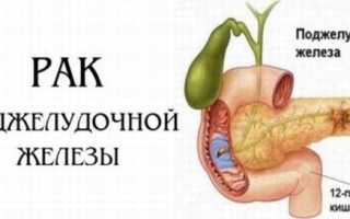 Что такое рак поджелудочной железы?