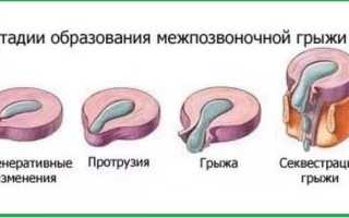 Как лечить грыжу позвоночника поясничного отдела