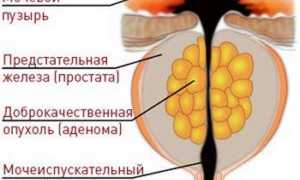 Недержание мочи после операции по удалению аденомы простаты