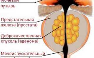 Недержание мочи после операции по удалению аденомы простаты
