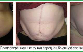 Что делать при грыже брюшной полости