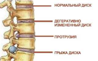 Выбираем лечебную физкультуру при грыже поясничного отдела позвоночника
