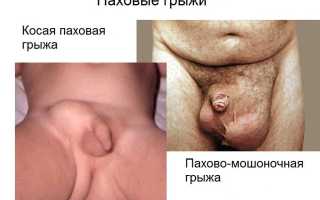 Симптомы паховой грыжи у мужчин