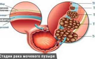 Переходноклеточный рак мочевого пузыря