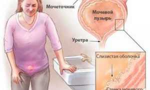 Цистит во время месячных