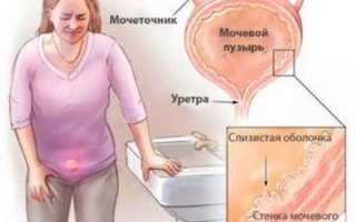 Цистит во время месячных