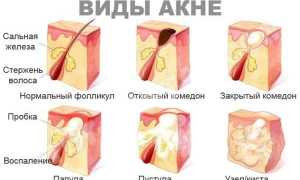 Симптомы и лечение кистозного акне