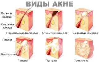 Симптомы и лечение кистозного акне