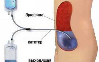 Перитонеальный диализ