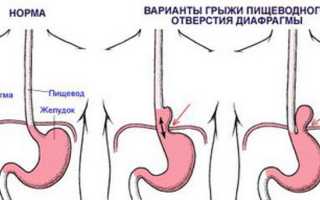 Грыжа желудка, что это такое и как ее лечить