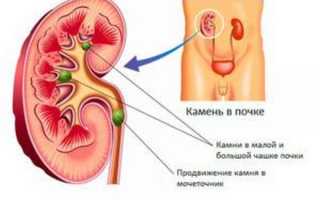 Удаление камней из почек