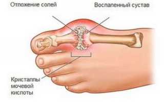 Что такое мочевая кислота
