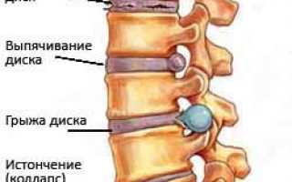Грыжа шейного отдела позвоночника, какие симптомы и лечение