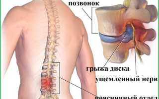 Что такое межпозвонковая грыжа и как ее лечить