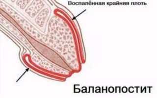 Как передается баланопостит
