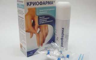 Как вывести папилломы с использованием Криофармы
