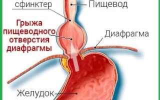 Что такое хиатальная грыжа и как ее лечить