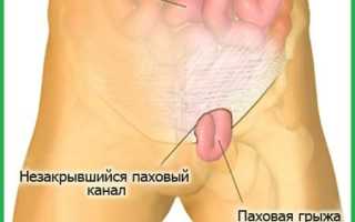 Лечебная гимнастика при паховой грыже