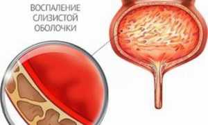 Пшено при цистите