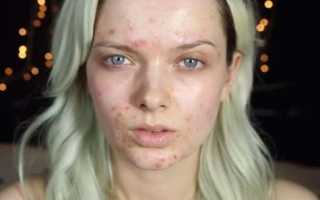 Особенности лечения акне ацетилсалициловой кислотой