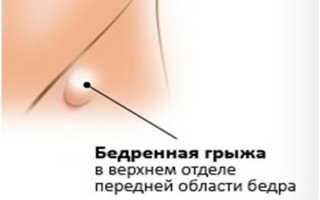 Как определить и лечить грыжу на бедре