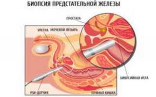 Биопсия предстательной железы