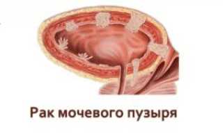 Рак мочевого пузыря