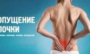 Опущение почки