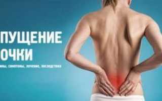 Опущение почки