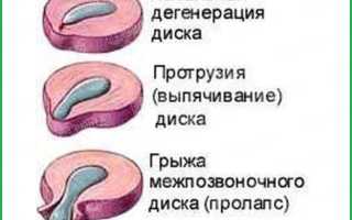 Протрузия дисков позвоночника поясничного отдела как лечить